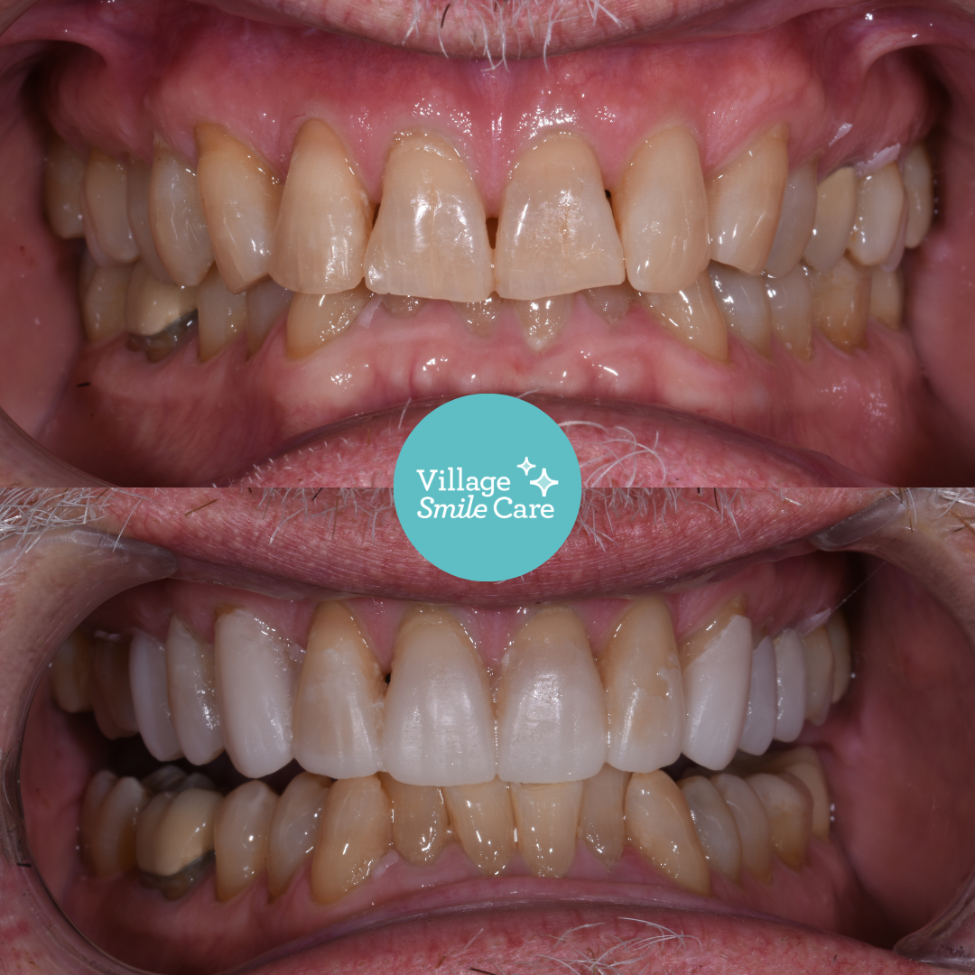 After teeth straightening treatment
