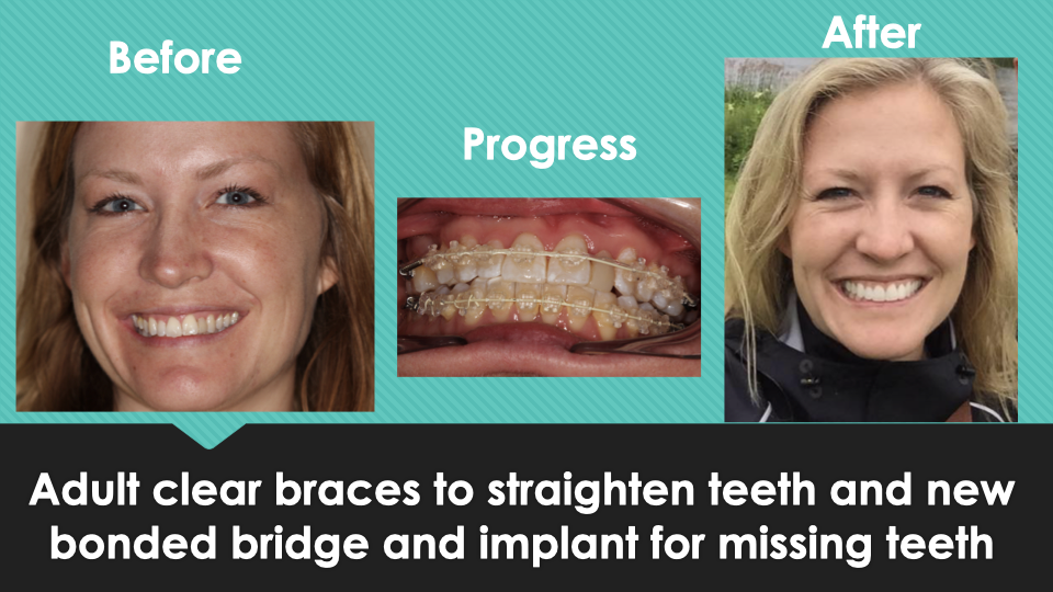 Patient Results at Village Smile Care