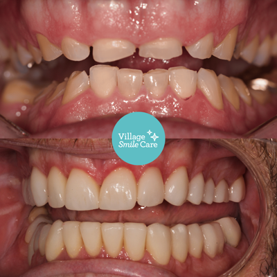 After teeth straightening treatment