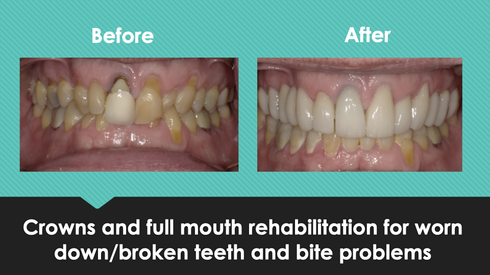 Patient Results at Village Smile Care