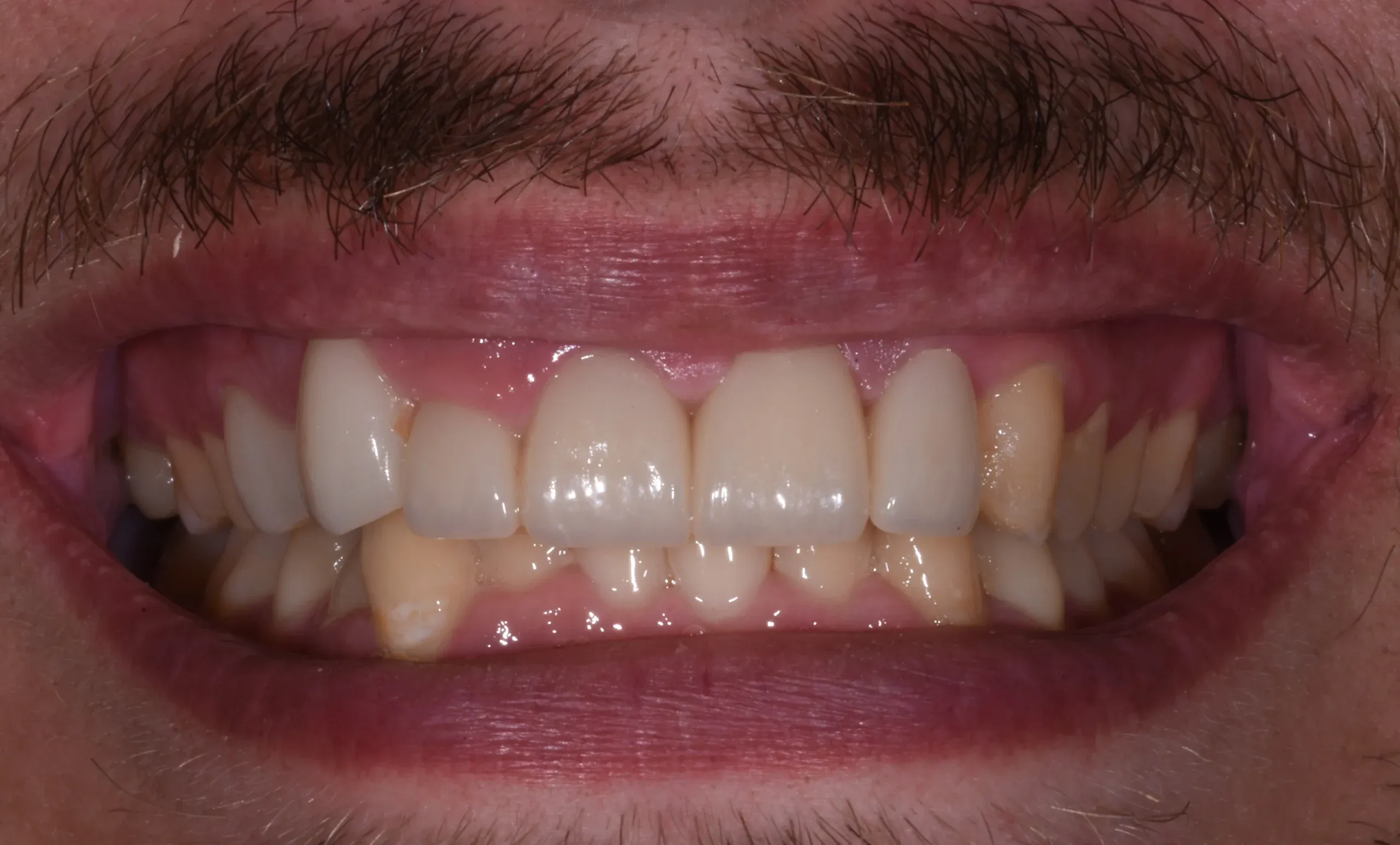 Restorative Dentistry at Village Smile Care