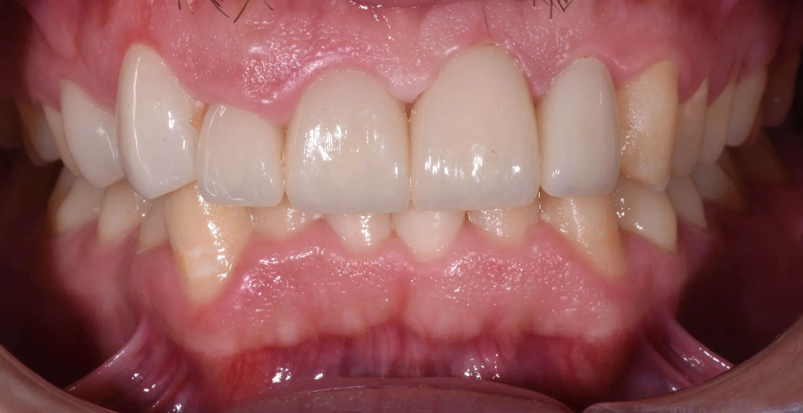 Restorative Dentistry at Village Smile Care