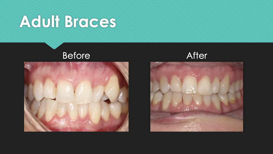 Patient Results at Village Smile Care