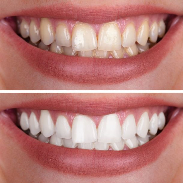 Common Myths and Misconceptions About Oral Surgery at Village Smile Care