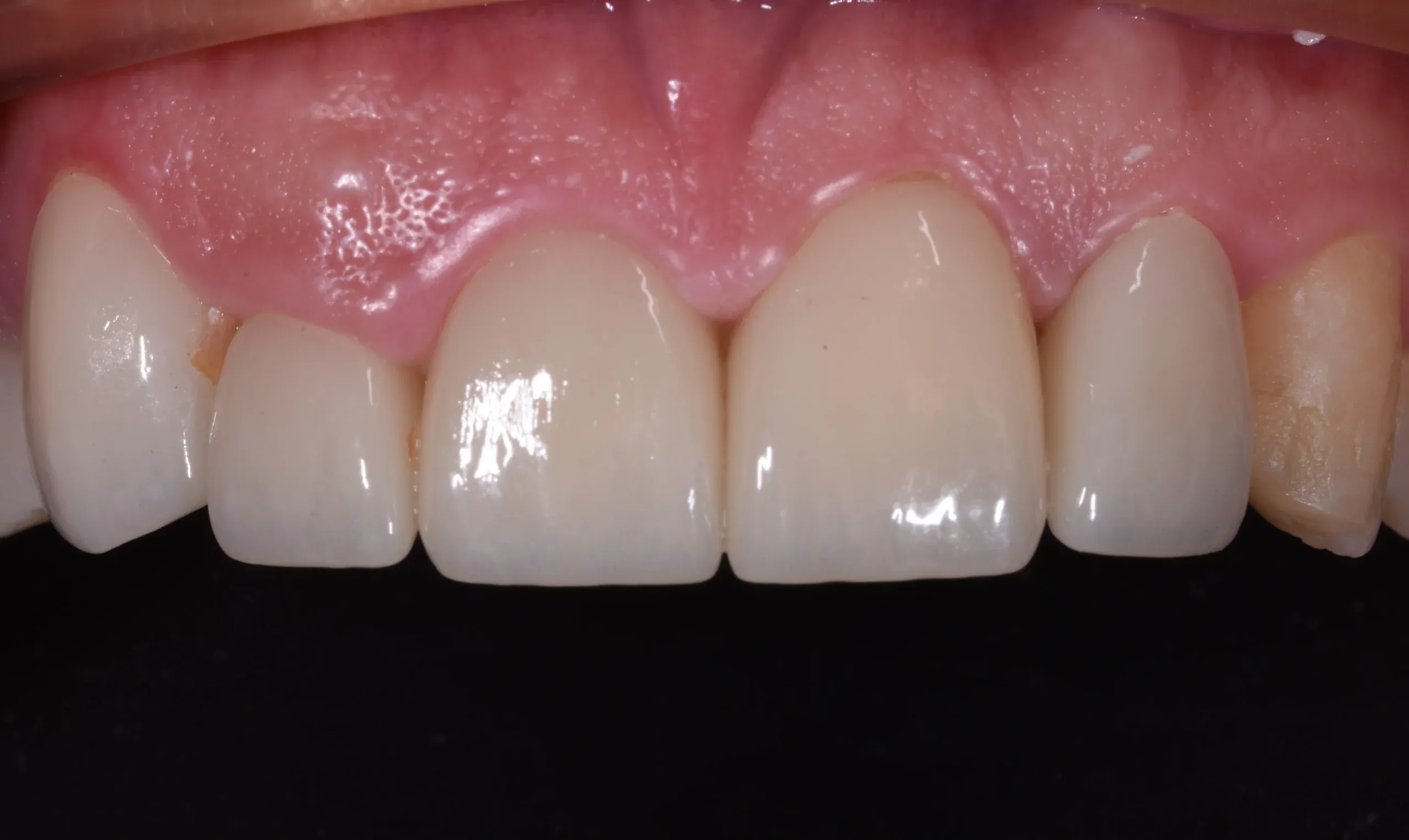 Restorative Dentistry at Village Smile Care
