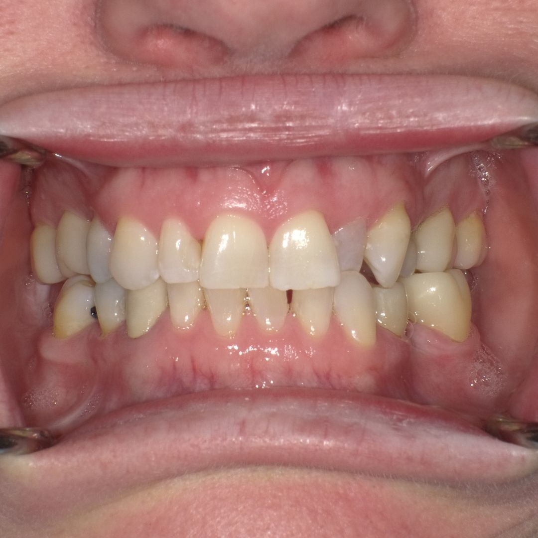 After teeth straightening treatment