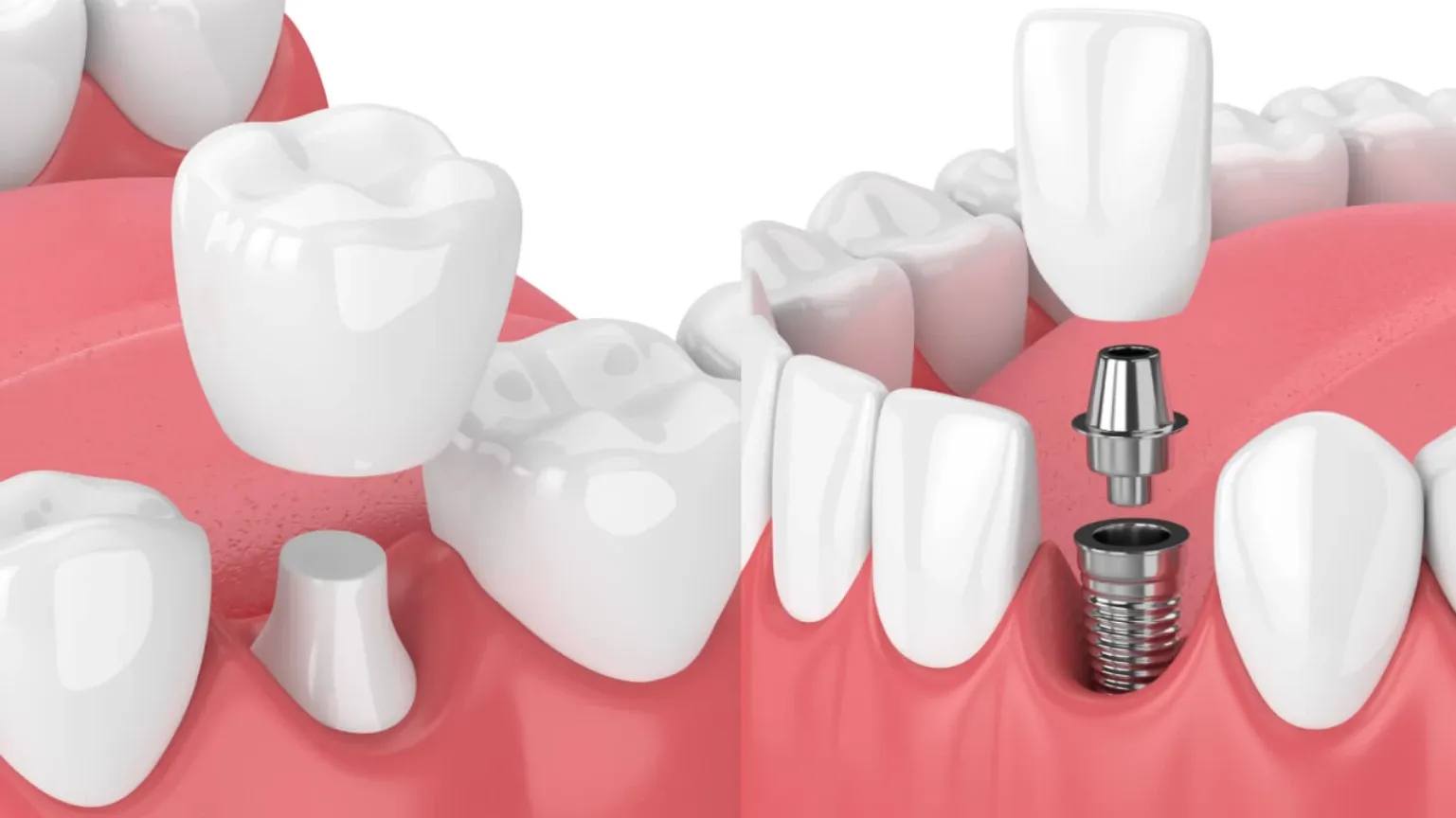 Dental Crowns vs. Implants Choosing the Right Restoration for You