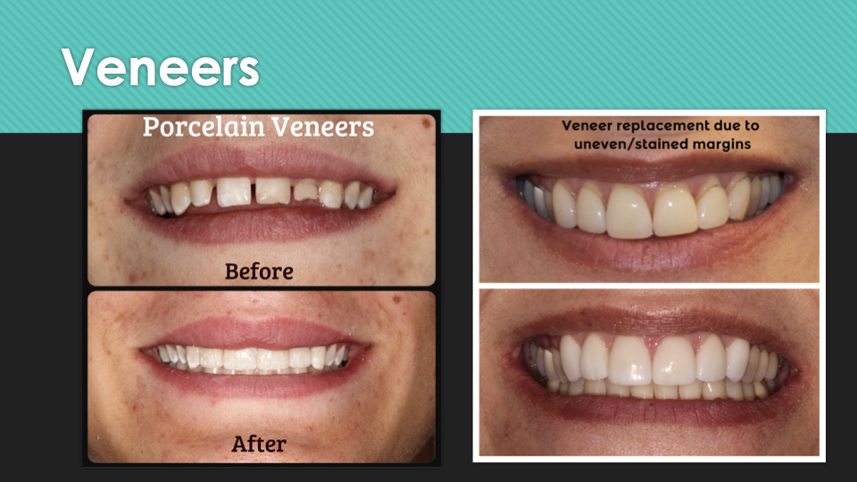 Patient Results at Village Smile Care