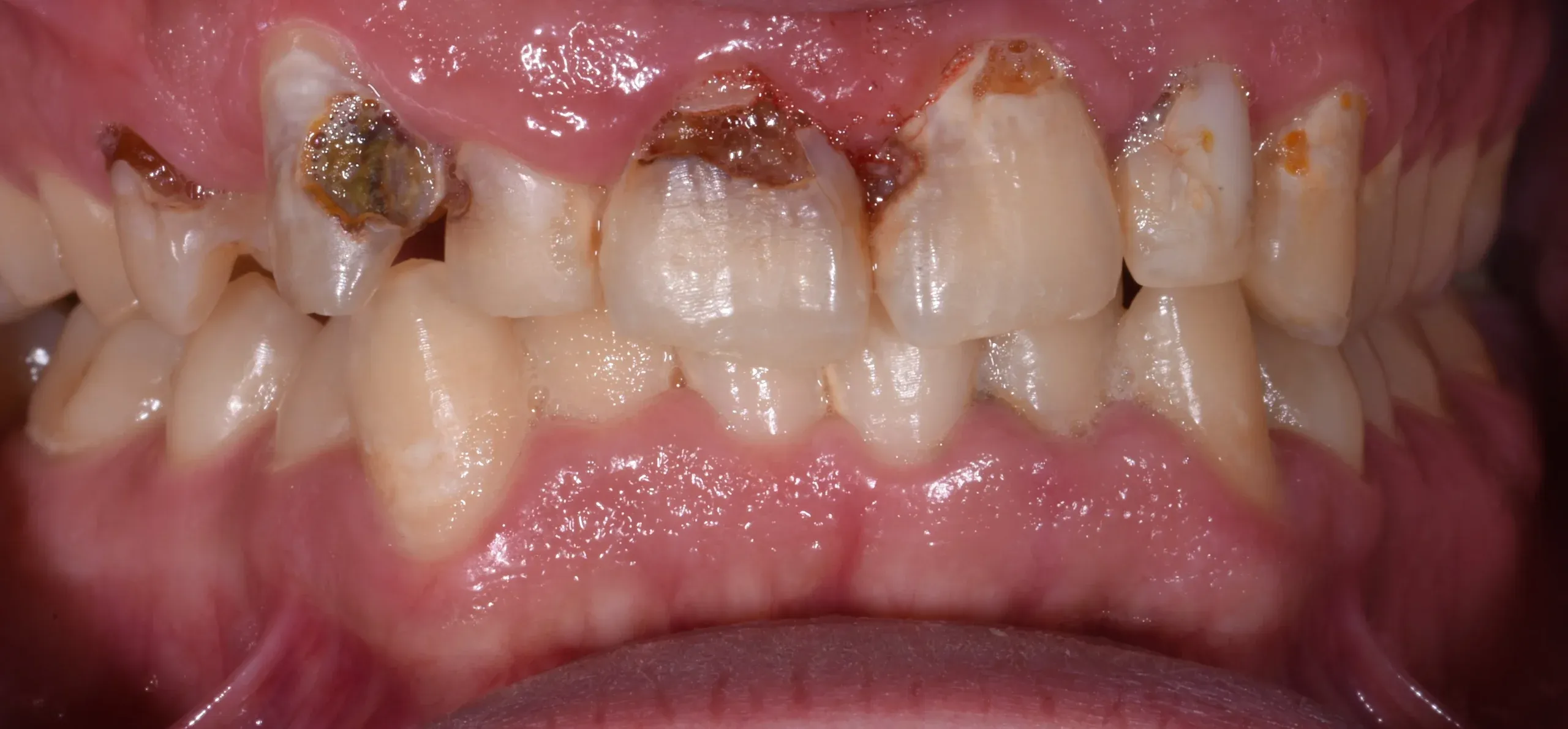 Restorative Dentistry at Village Smile Care