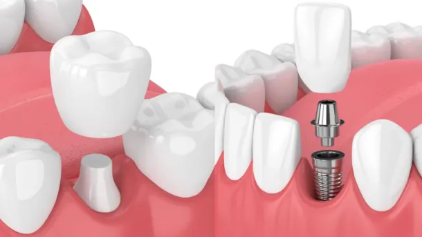 Dental Crowns vs. Implants: Choosing the Right Restoration for You at Village Smile Care