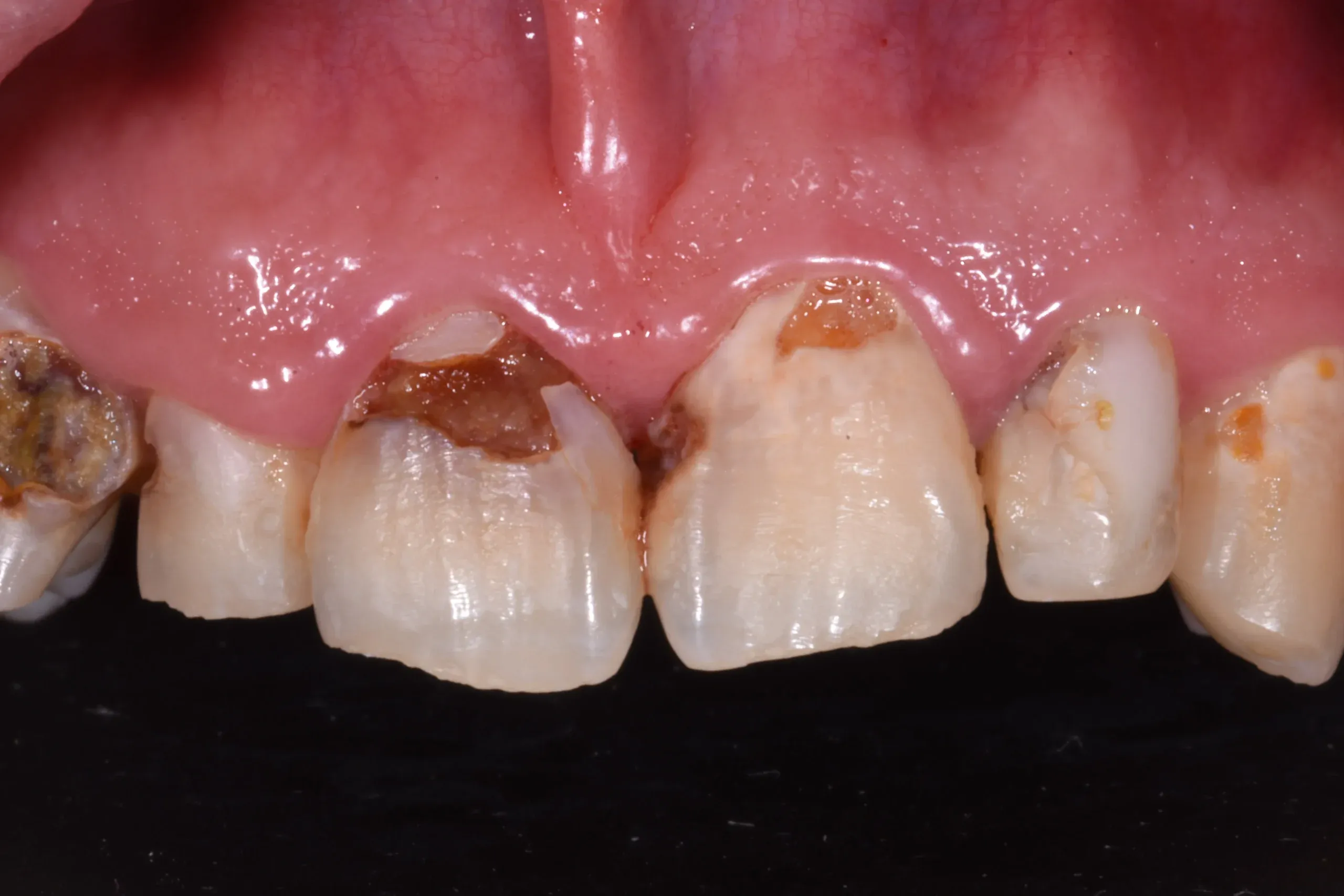 Restorative Dentistry at Village Smile Care