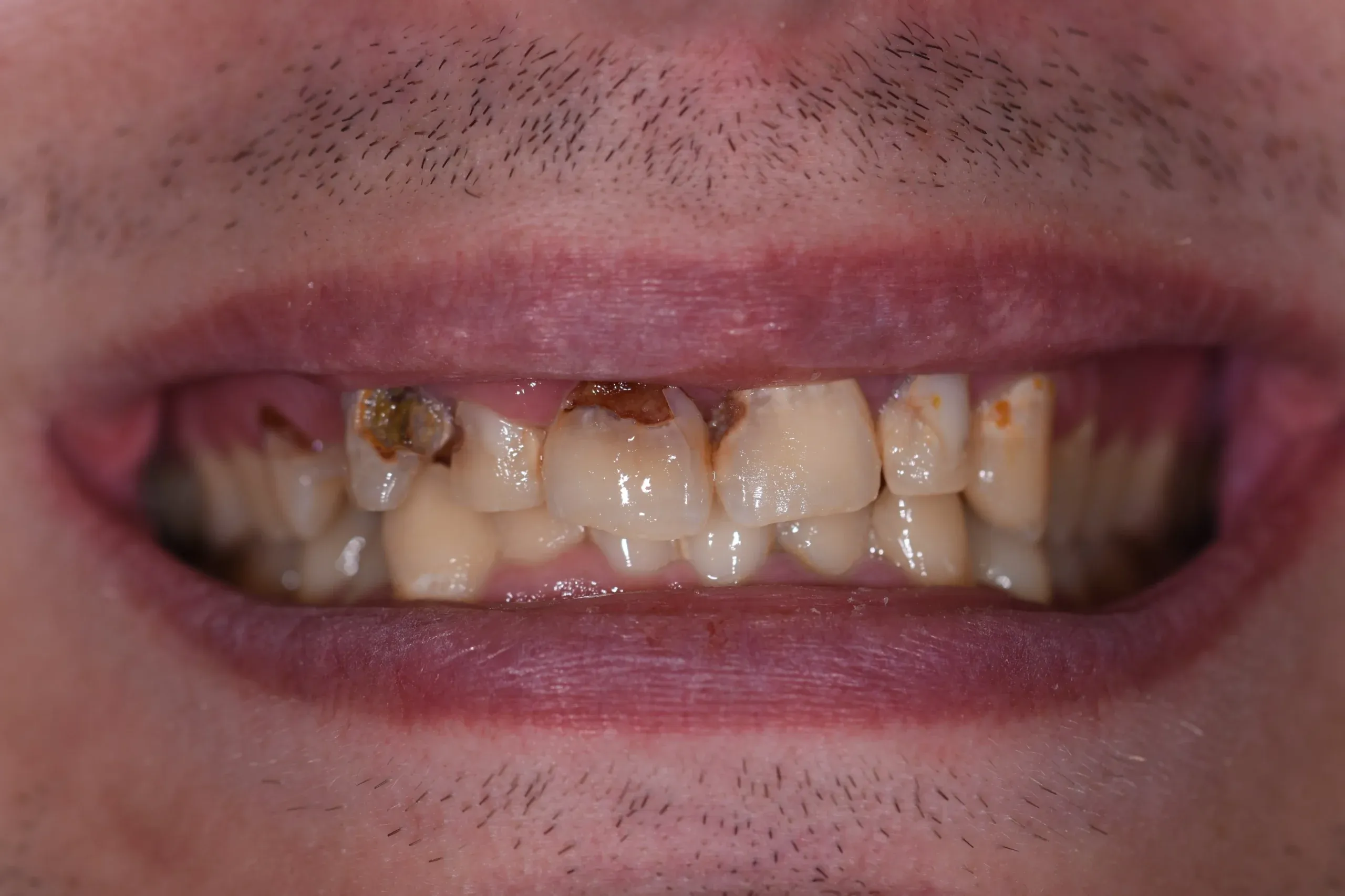 Restorative Dentistry at Village Smile Care