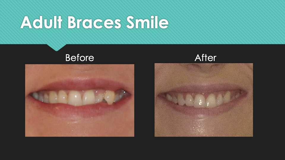 Patient Results at Village Smile Care