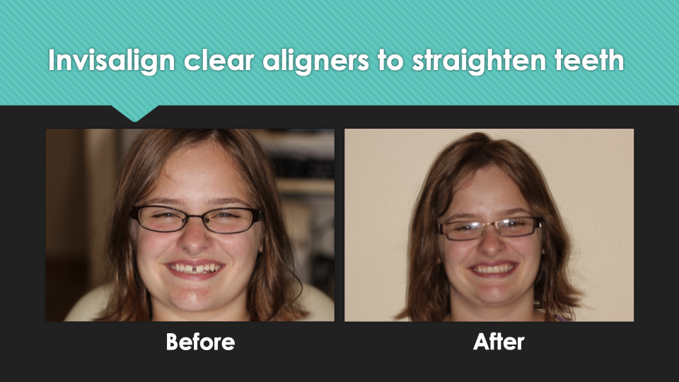 Patient Results at Village Smile Care