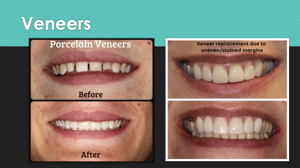 Dental Veneers treatment photo