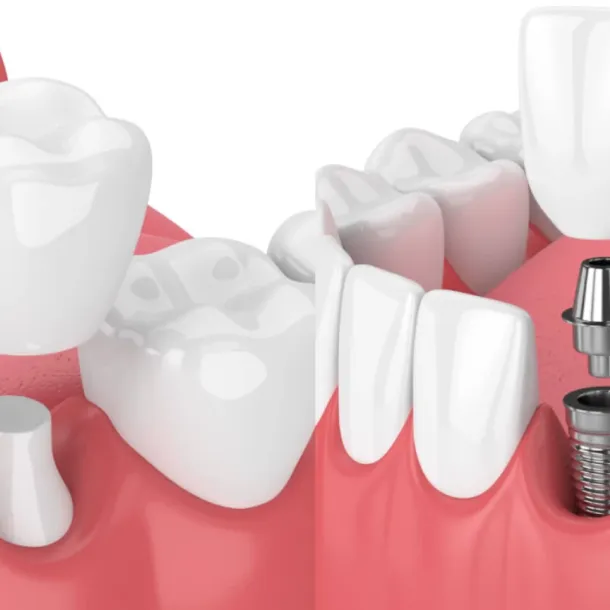 When to Consider Denture Relining or Refitting at Village Smile Care