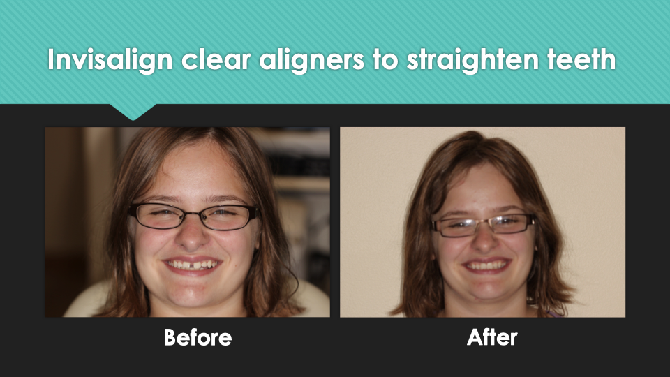 Invisalign® at Village Smile Care