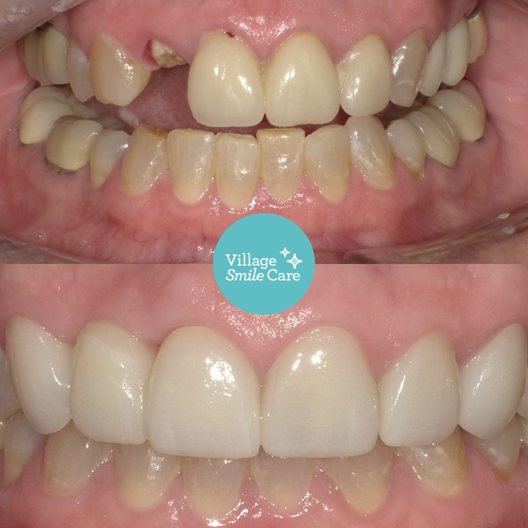 Before teeth straightening treatment