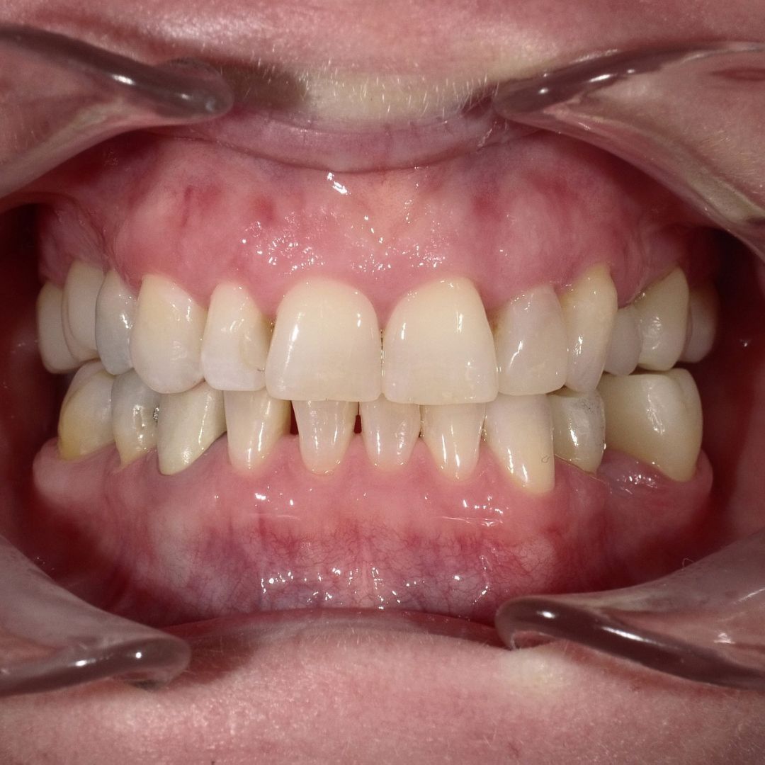 After teeth straightening treatment