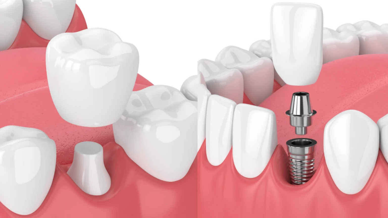 Dental Implants: The Modern Solution for Missing Teeth